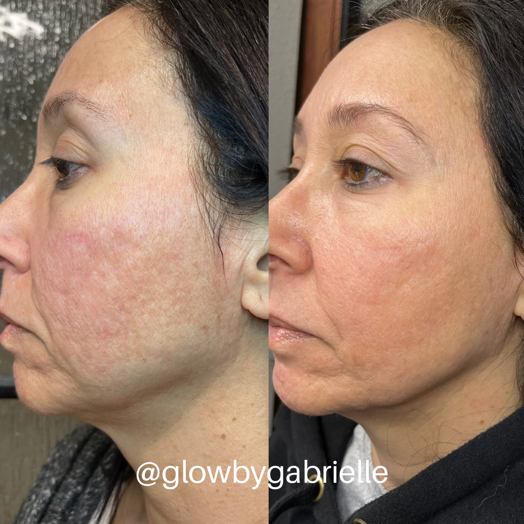 A Lamelle Chemical Peel With Microneedling in Claremont